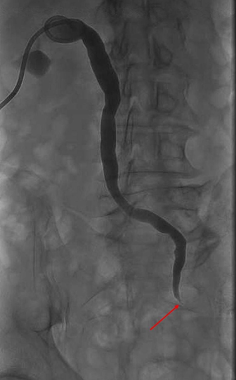 Unraveling the Complexities of Uretero-Enteric Strictures: A Modern Review