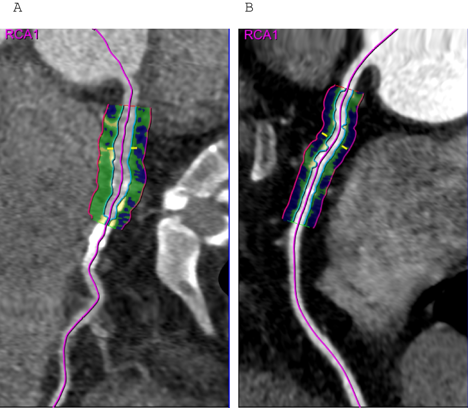 Pericoronary Fat Attenuation: Diagnosis and Clinical Implications