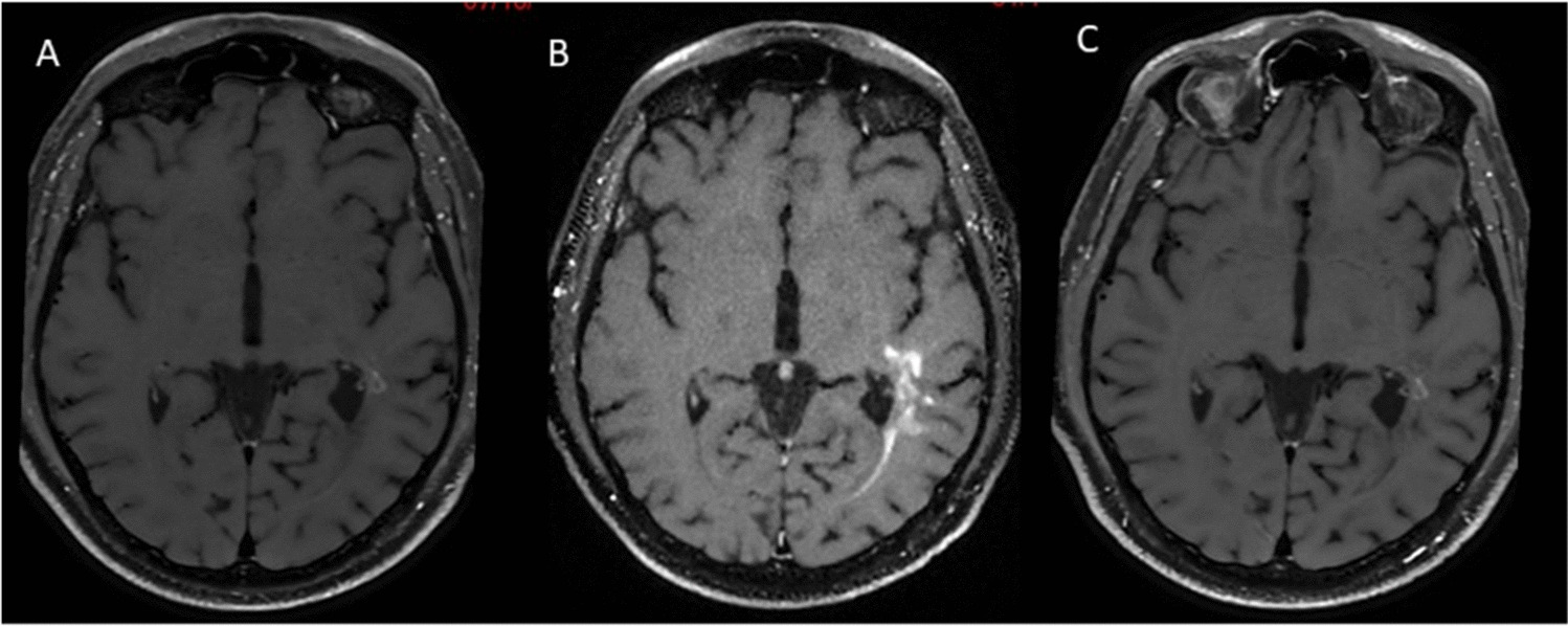 CAR T-cell Therapy for Central Nervous System Lymphoma