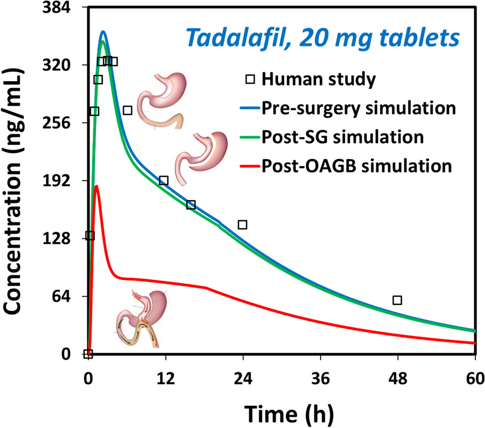 Erectile Dysfunction Therapy of Bariatric Patients: Tadalafil Biopharmaceutics and Pharmacokinetics Before vs. After Gastric Sleeve/Bypass