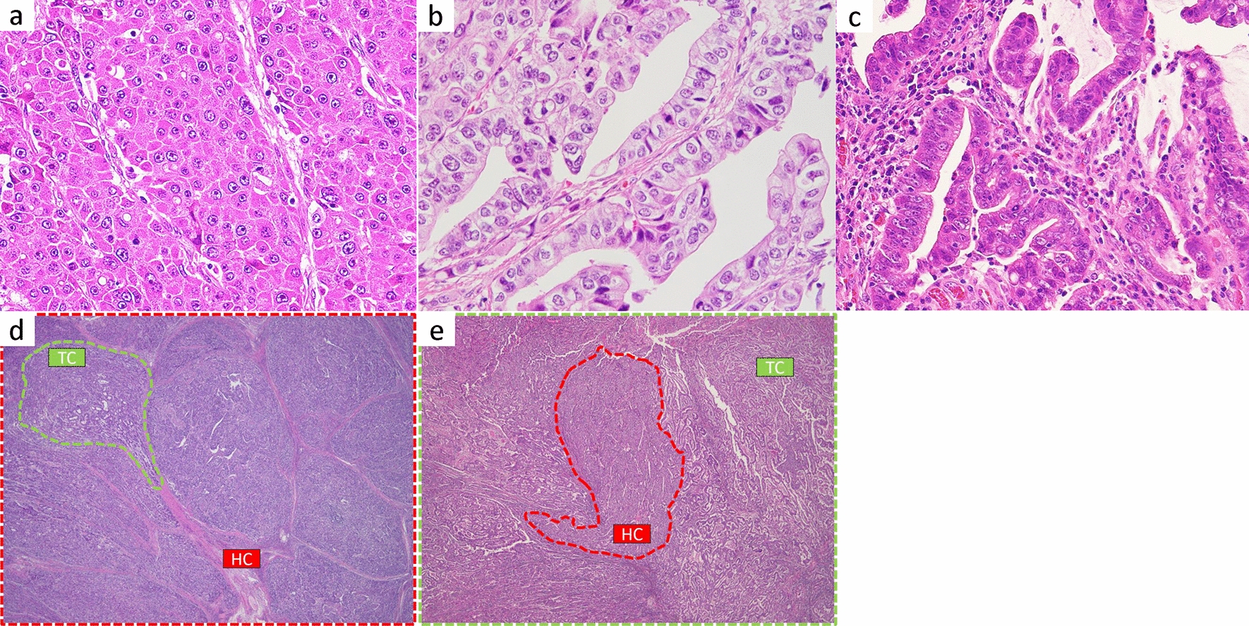 Volume of hepatoid component and intratumor M2 macrophages predict prognosis in patients with hepatoid adenocarcinoma of the stomach