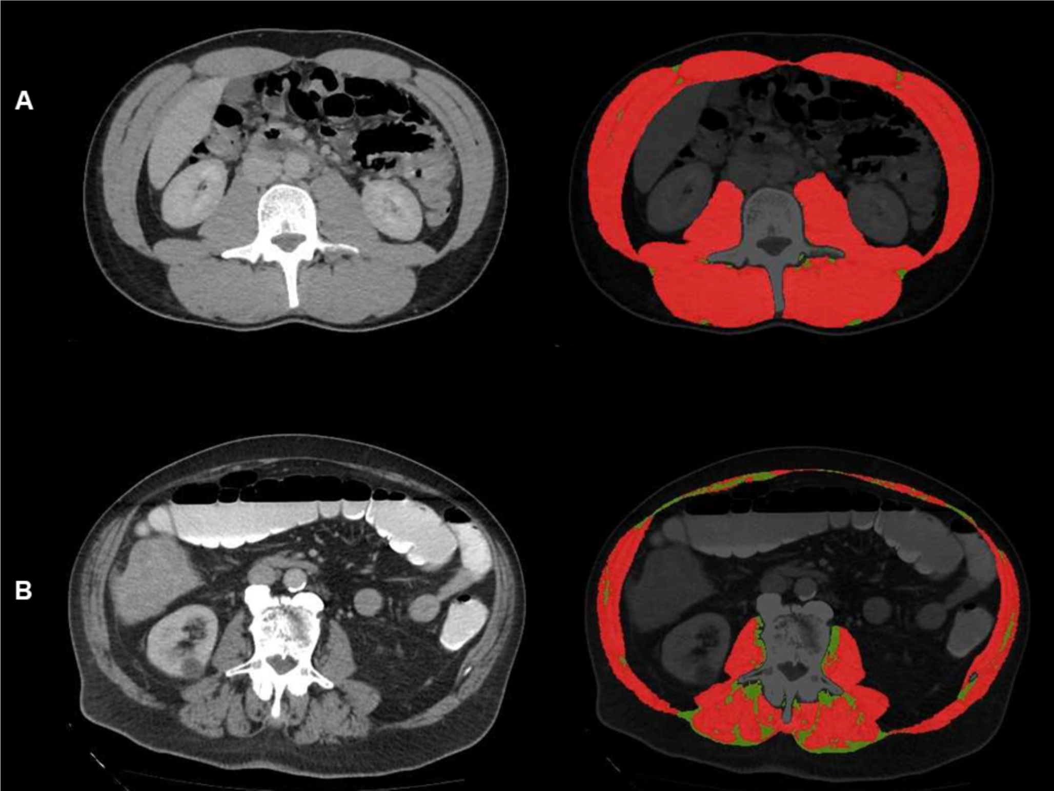 Albumin-muscle density score predicts overall survival in patients with hepatocellular cancer undergoing treatment with transarterial chemoembolization