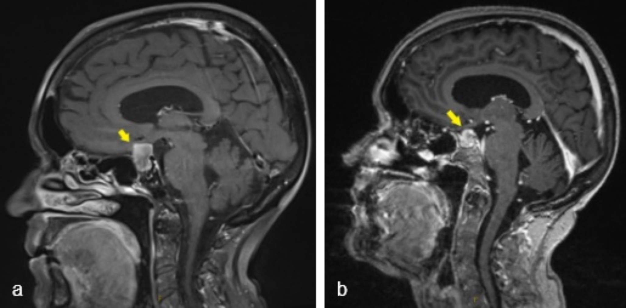 An unusual case of primary pituitary abscess due to Corynebacterium pseudodiphtheriticum