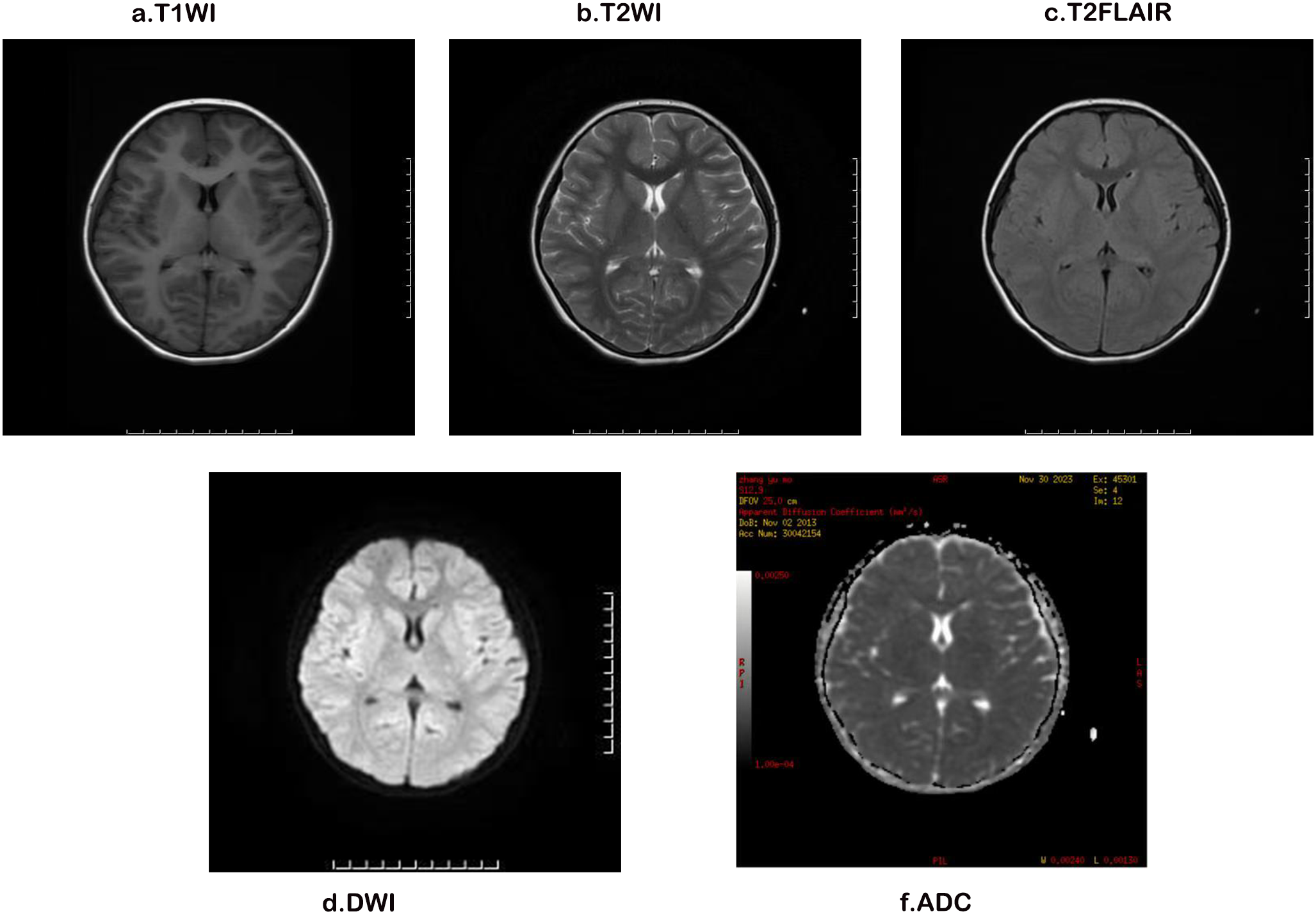 Case report: diagnosis of neurobrucellosis in a non-endemic area child using metagenomic next-generation sequencing