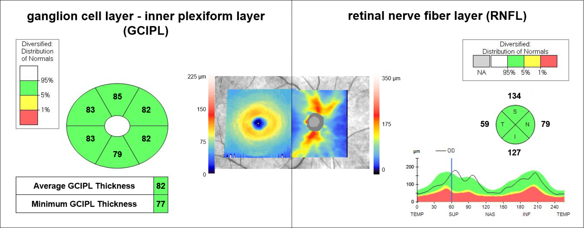 Retinal thickness predicts the risk of cognitive decline over five years