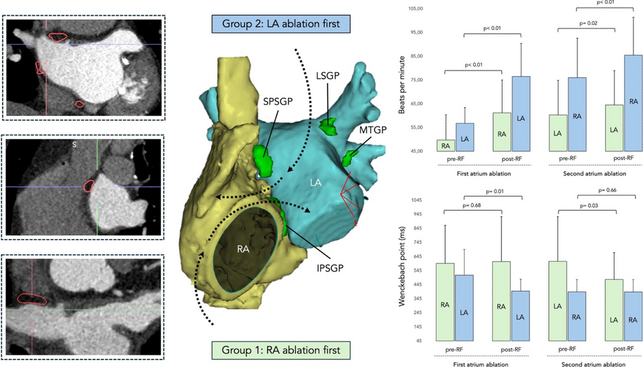 Differential and synergistic effects of right and left atrial ganglionated plexi ablation in patients undergoing cardioneuroablation: results from the ELEGANCE multicenter study