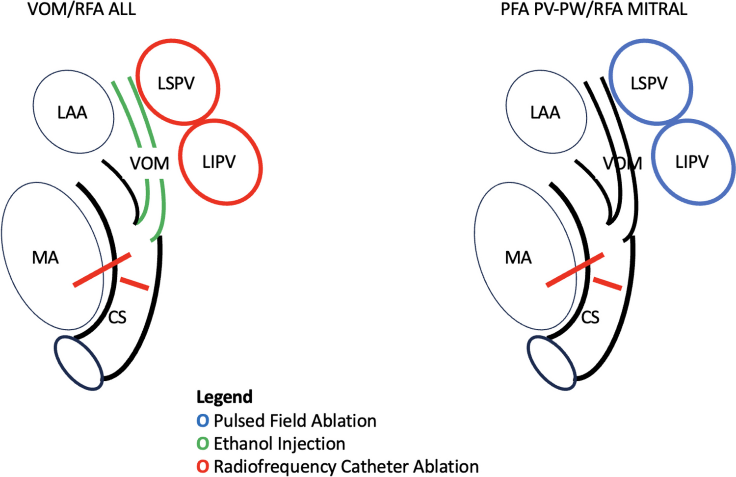 Acute mitral block: pulse field ablation plus radiofrequency ablation when compared to radiofrequency ablation plus ethanol injection of vein of Marshall