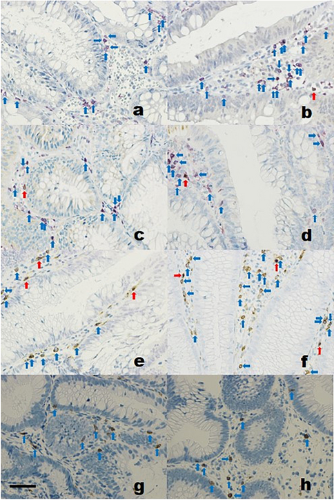 Both Th1 and Th2 CD4 + T-Cell Lineage Infiltrations Decrease in Post-hematopoietic Stem Cell Transplantation Colon Adenoma