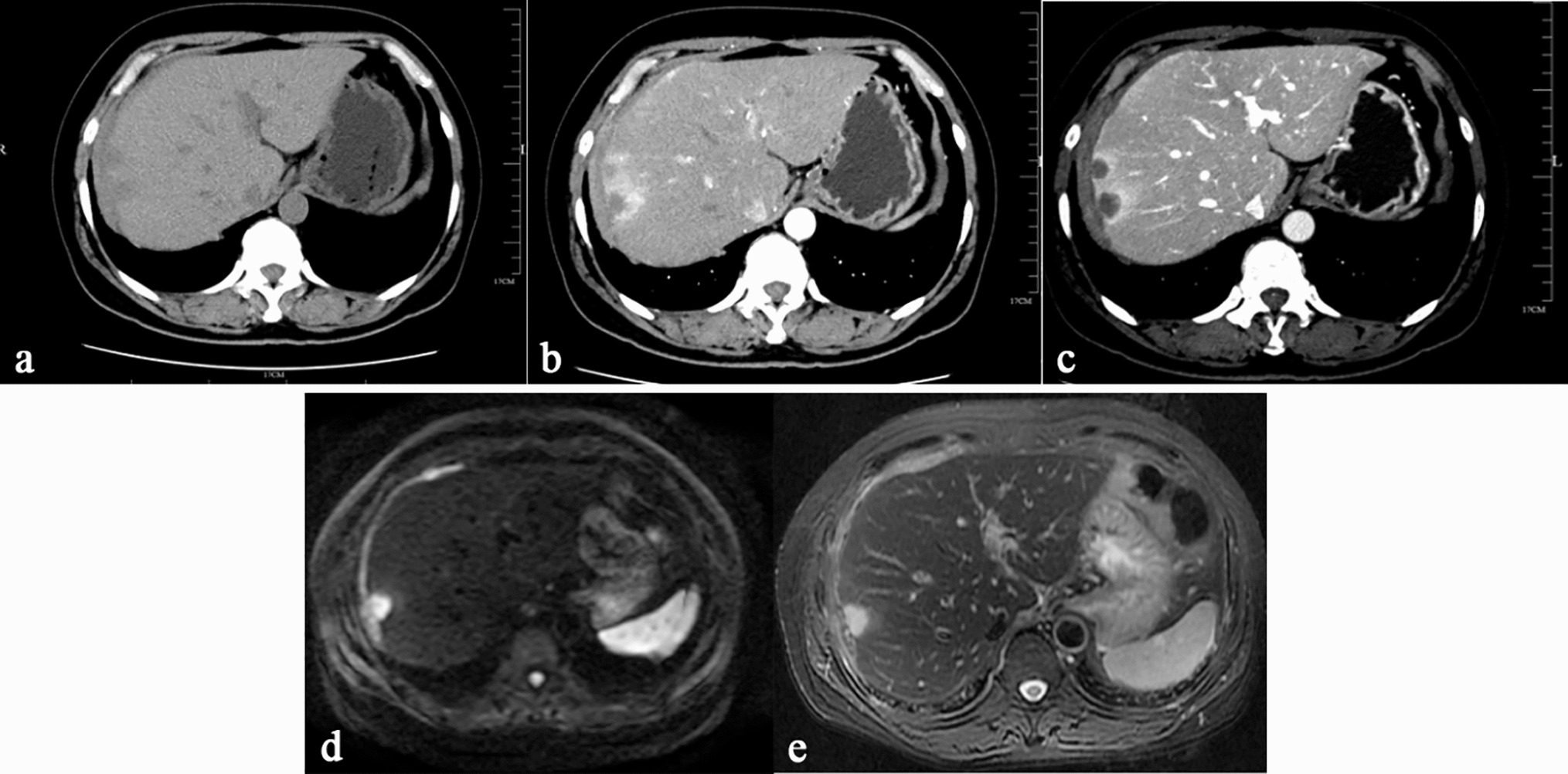 Primary Intrahepatic Mesothelioma: Case Series and Systematic Review of Literature