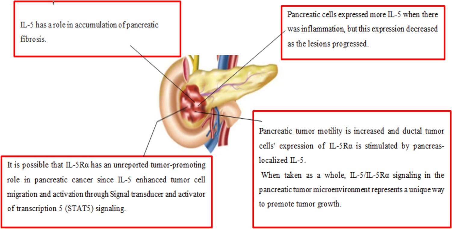 Role of Interleukins in Pancreatic Cancer: A Literature Review