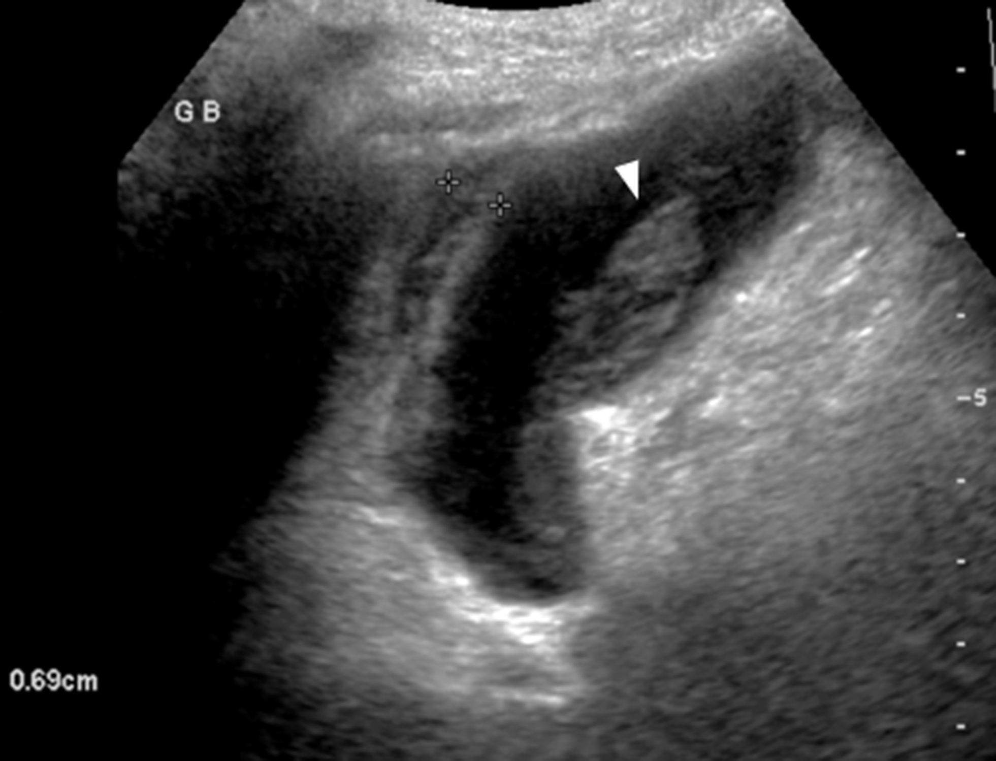 Acalculous cholecystitis– an imaging and therapeutic update