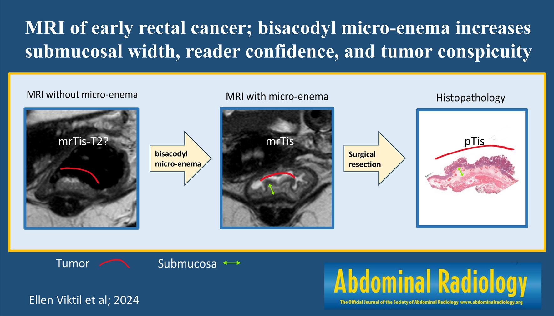 MRI of early rectal cancer; bisacodyl micro-enema increases submucosal width, reader confidence, and tumor conspicuity