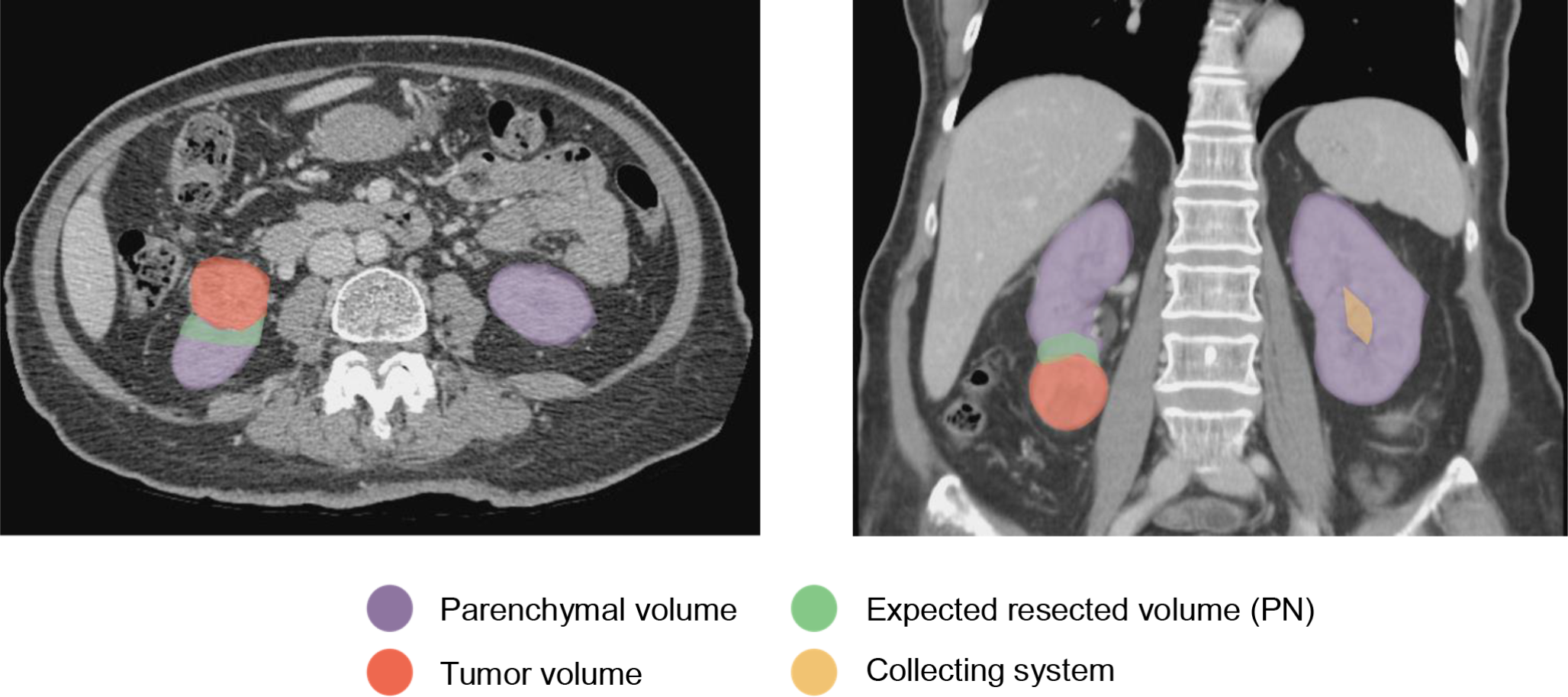 CT volumetric analysis: association of renal parenchyma and GFR alteration in nephrectomy patients