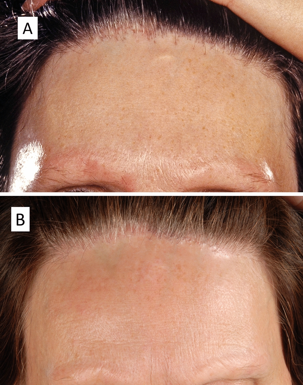 Frontal Fibrosing Alopecia: An Update