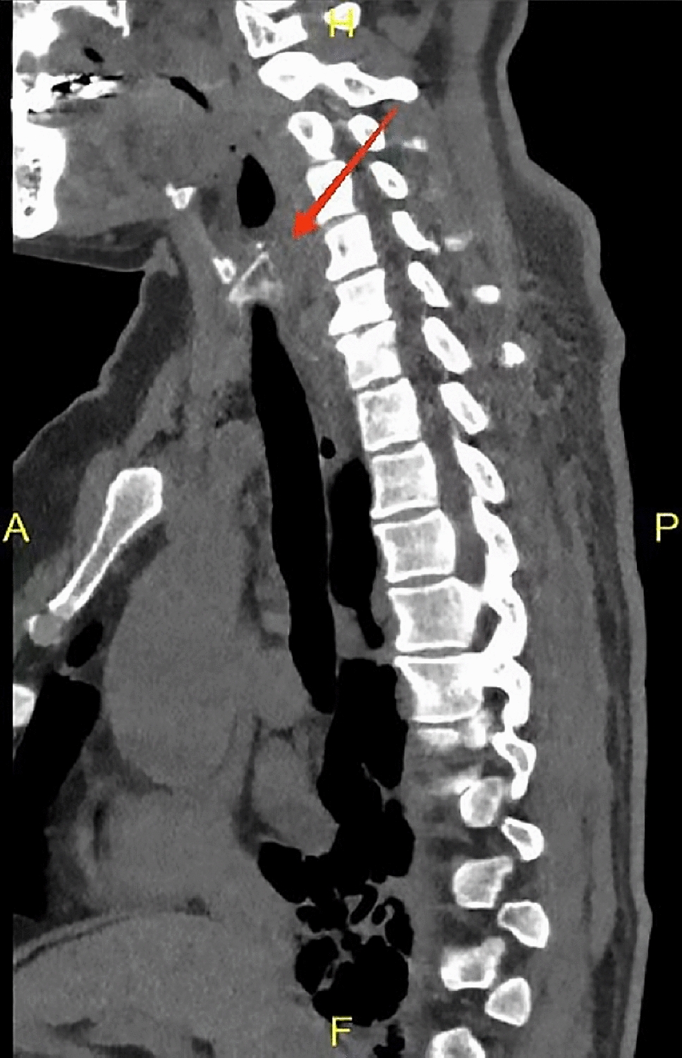 Chest CT Combined with Endoscopic Ultrasound Incision of the Mucosa and Removal of a Fish Bone (with Video)