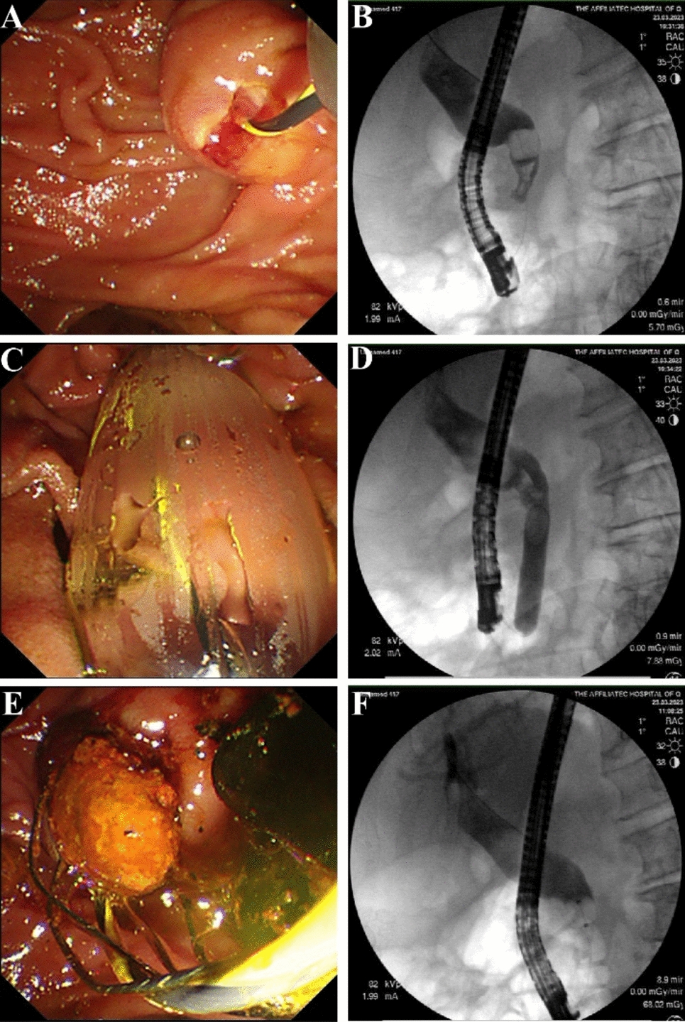 Endoscopic Papillary Large Balloon Dilatation With or Without Endoscopic Sphincterotomy in the Treatment of Common Bile Duct Stones