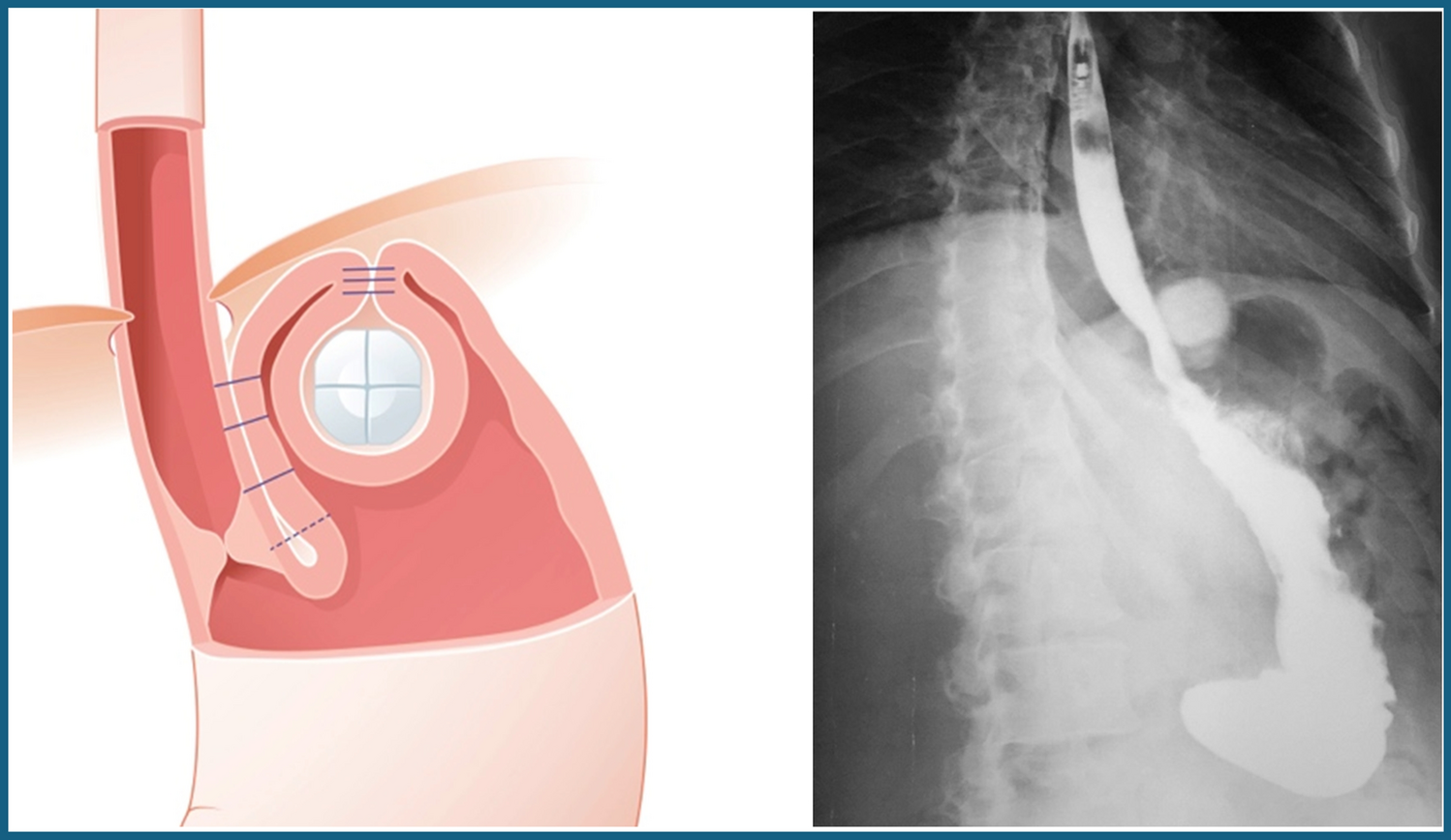 Acid Reflux Management with the RefluxStop Implant: A Prospective Multicenter Trial with 3-Year Outcomes