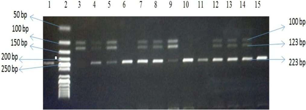 Association between FTO gene polymorphism and obesity in down syndrome children