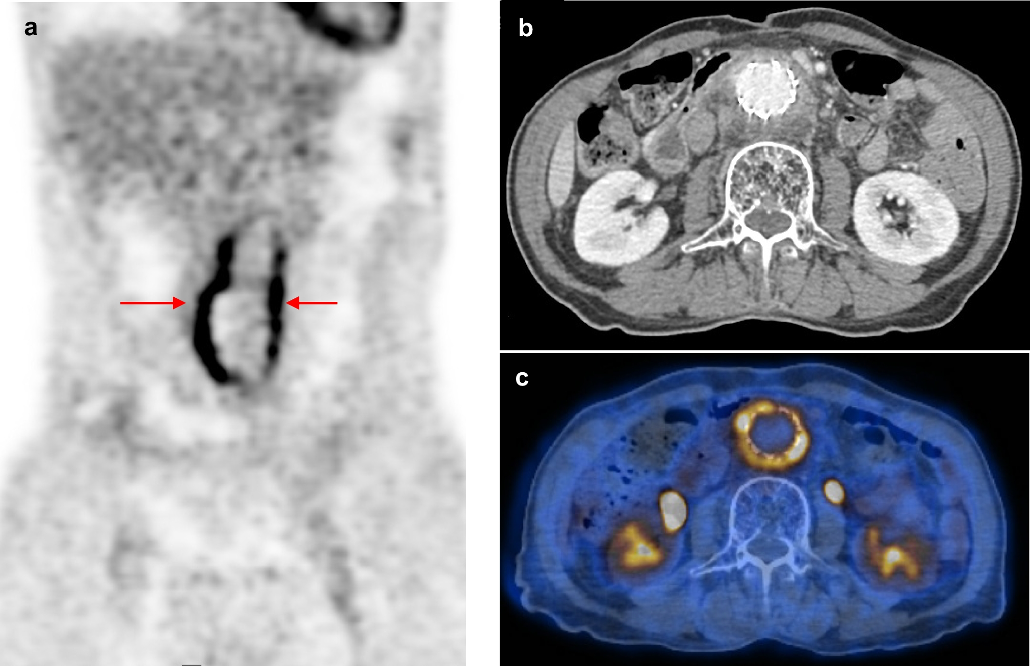 18F-FDG PET/CT in Inflammation and Infection: Procedural Guideline by the Korean Society of Nuclear Medicine