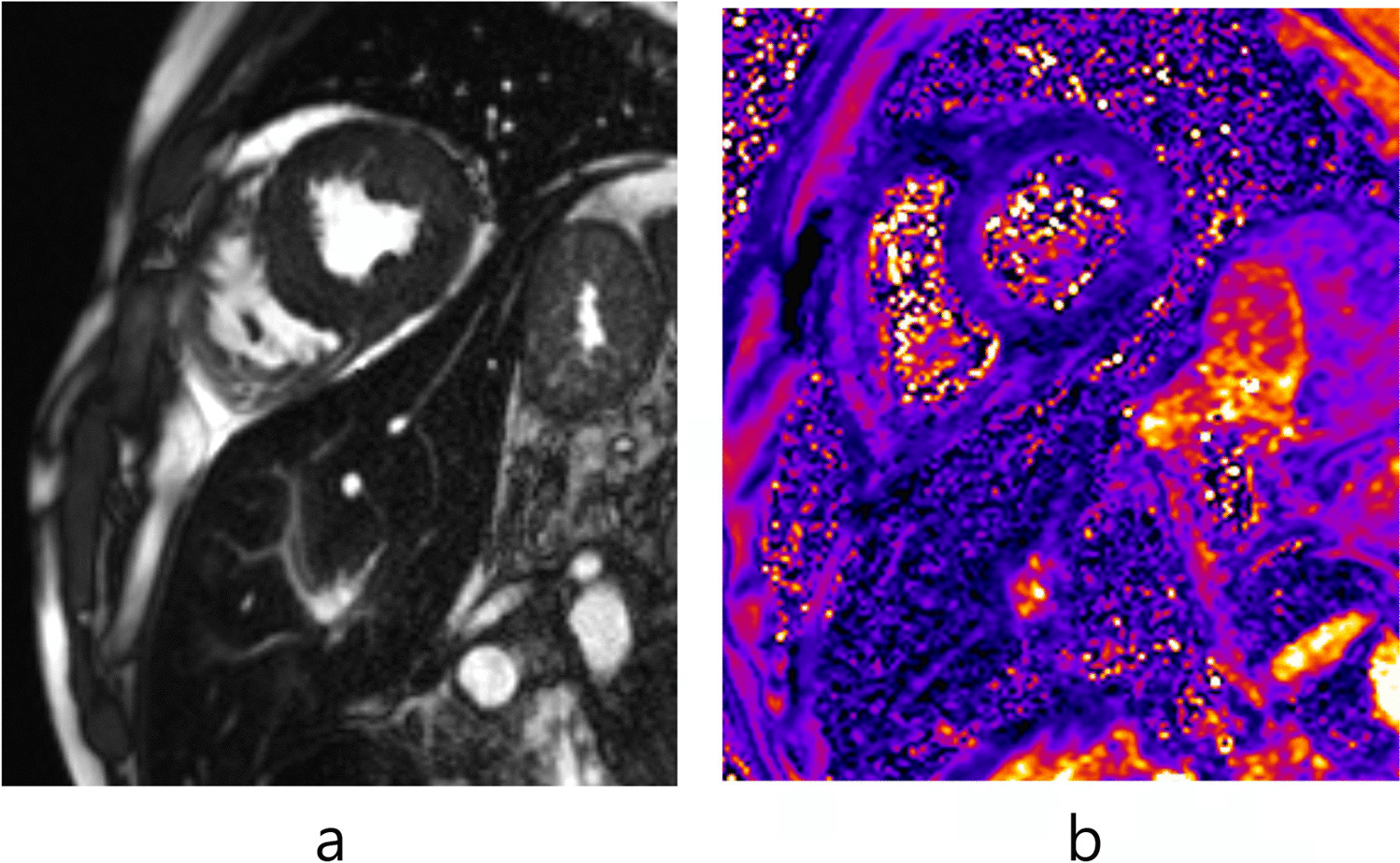 Recent Progress of Cardiac MRI for Nuclear Medicine Professionals