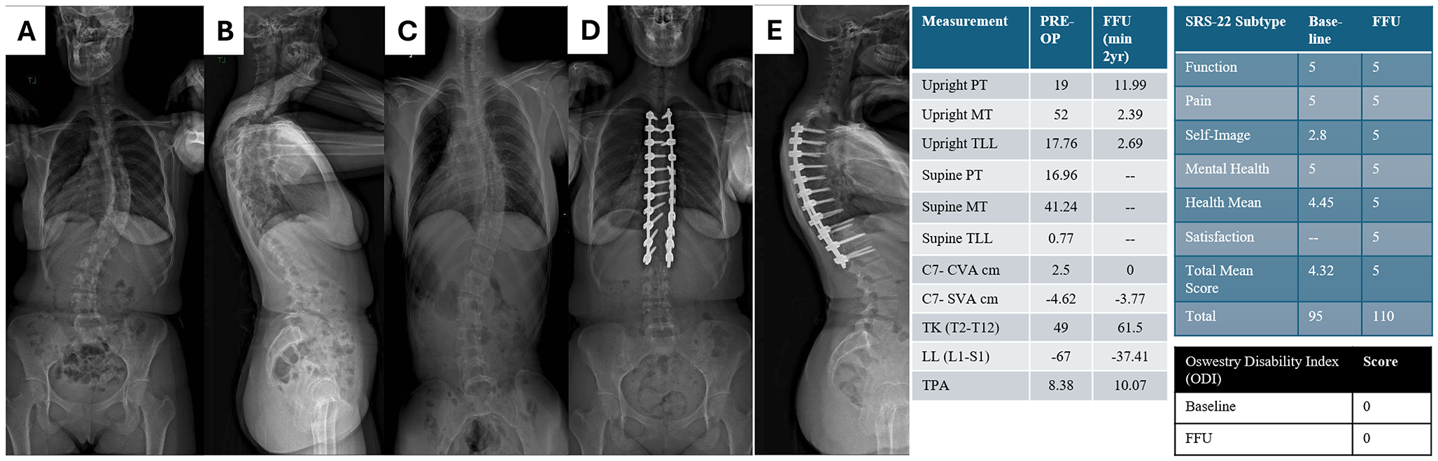 Adolescent vs. Young Adult Idiopathic Scoliosis patients: how different are their two year postoperative radiographic and clinical outcomes?