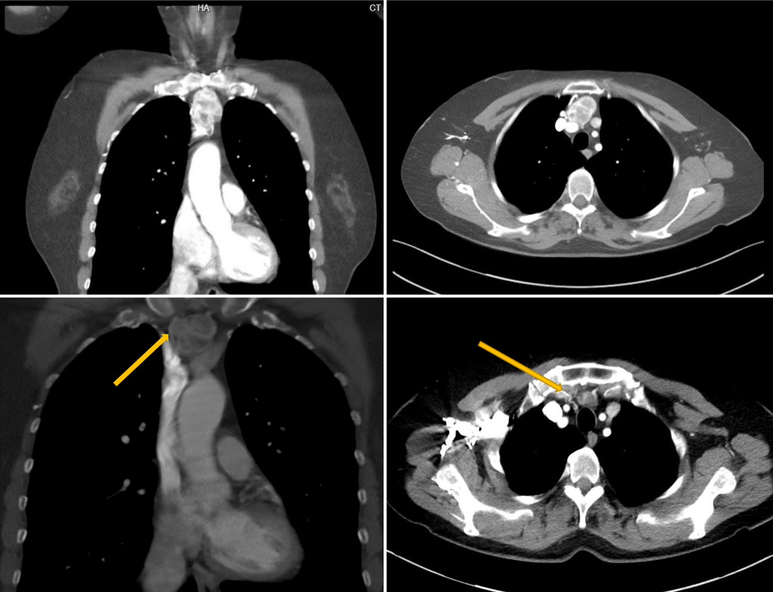 Robot-assisted thoracoscopic surgery of primary and secondary intrathoracic goiter