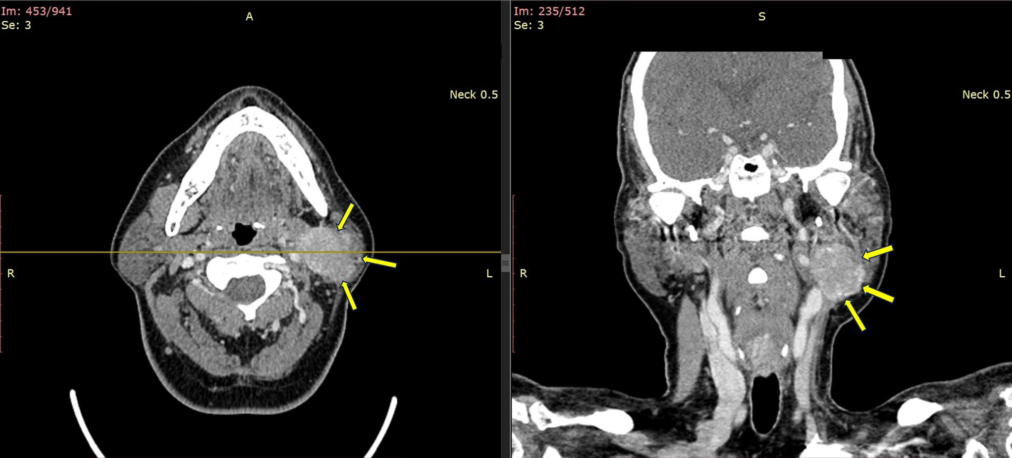 Metachronous metastasis of papillary thyroid carcinoma to the parotid gland: a case report and review of the literature