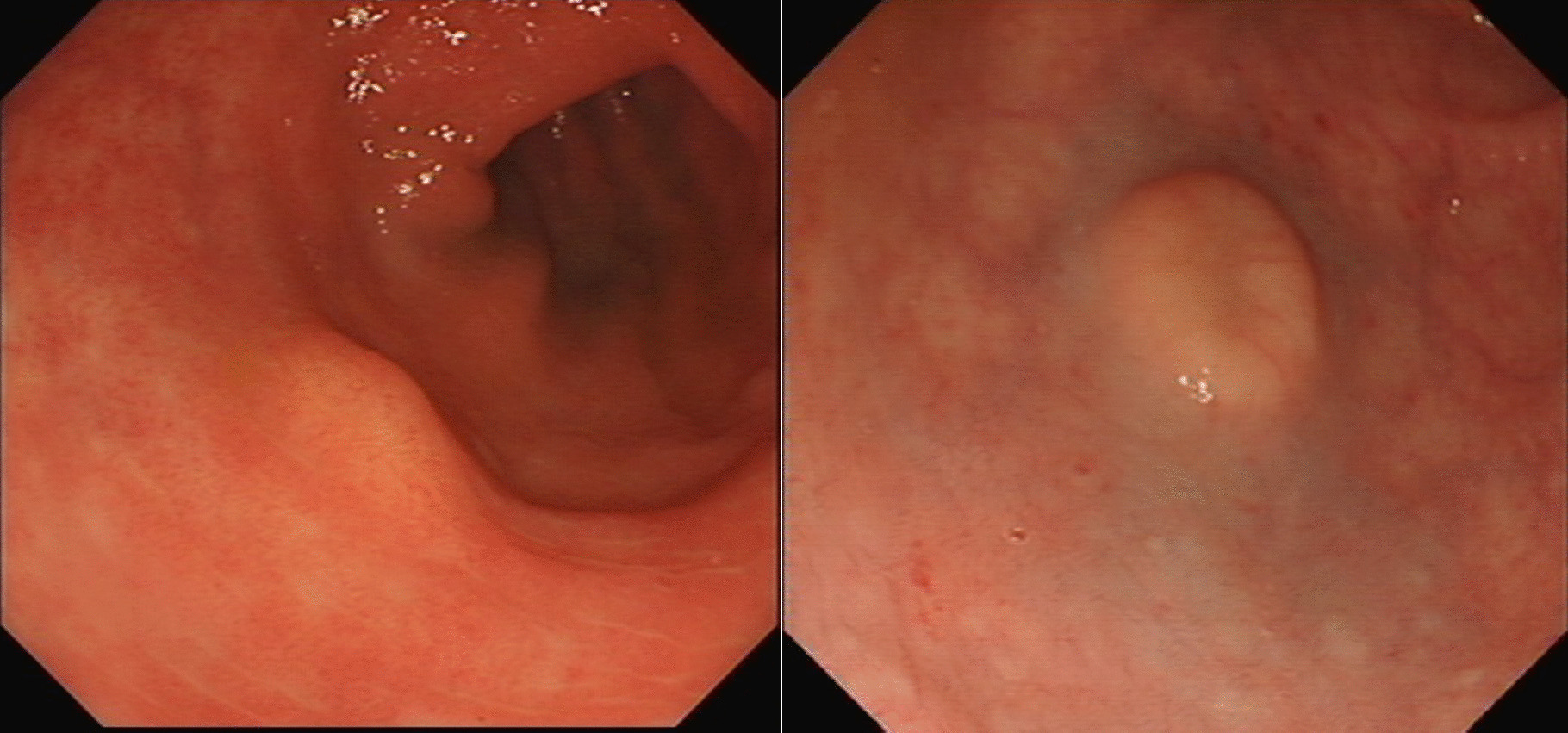 An Update on the Management of Rectal Neuroendocrine Neoplasms