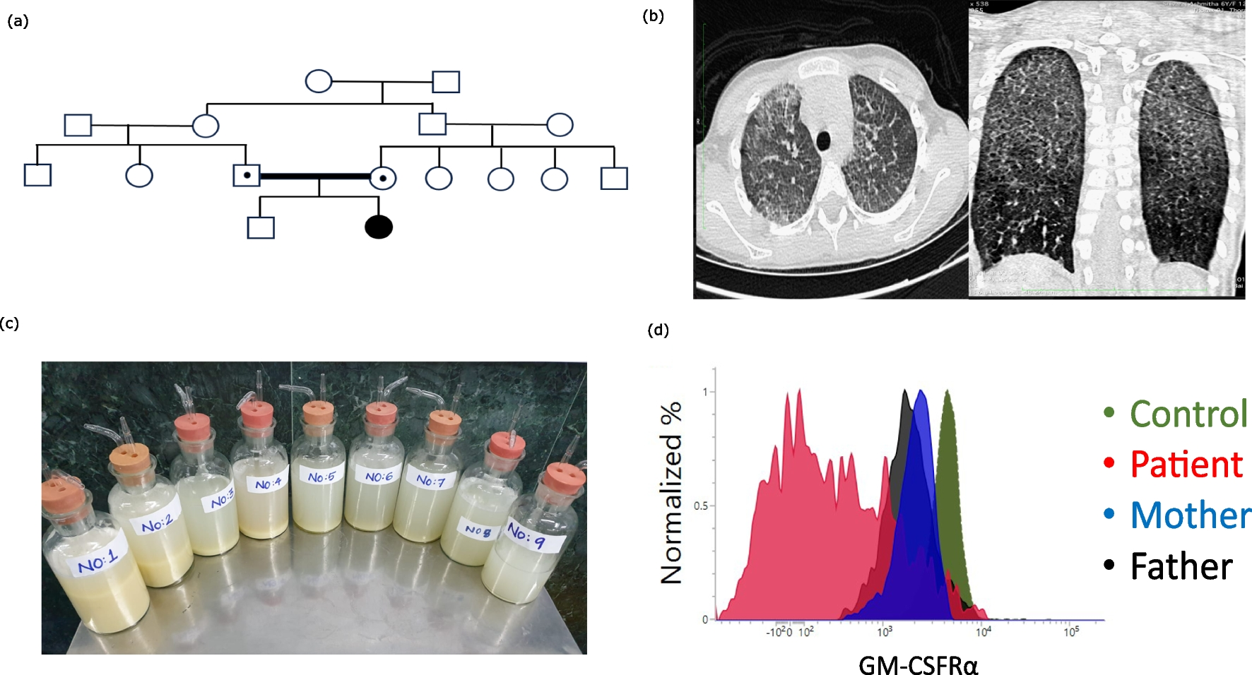 Restitutio ad integrum: Rescuing the Alveolar Macrophage Function with HSCT in Pulmonary Alveolar Proteinosis Due to CSF2Rα Deficiency