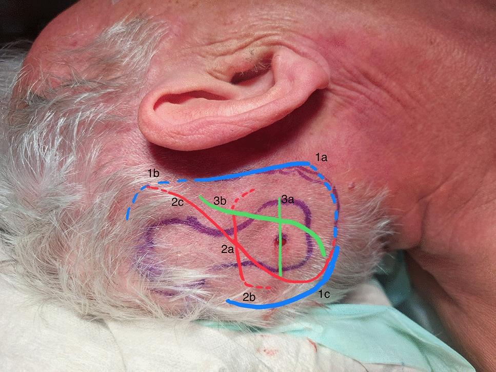 How I do it: Modified operation technique for MR Conditional OSIA 3: anterior based flap for covering the implant