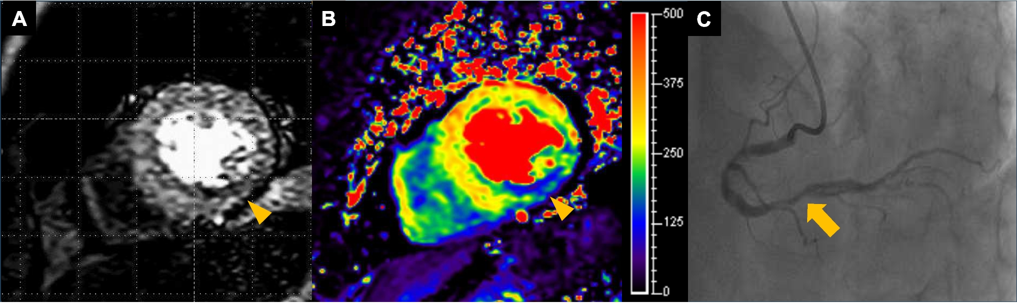 Understanding Myocardial Ischemia: Cardiac Magnetic Resonance Insight Into Coronary Macro- and Microcirculation Pathophysiology