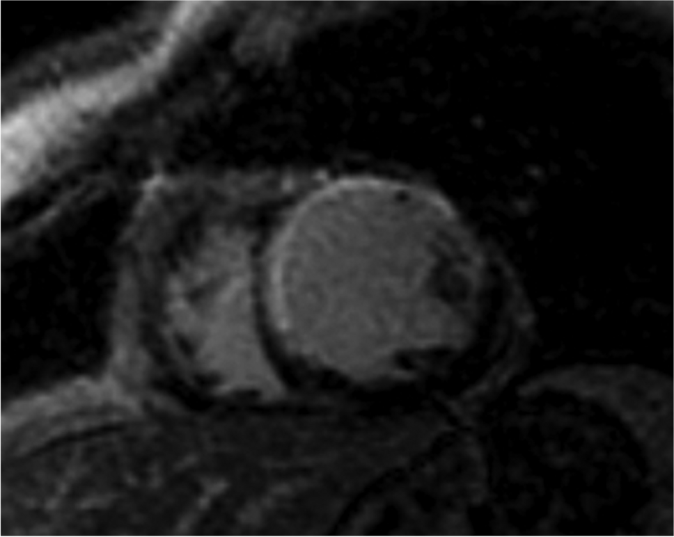 Cardio-Rheumatology: From Inflammation to Heart Failure. The Emerging Role of Cardiovascular Magnetic Resonance Imaging