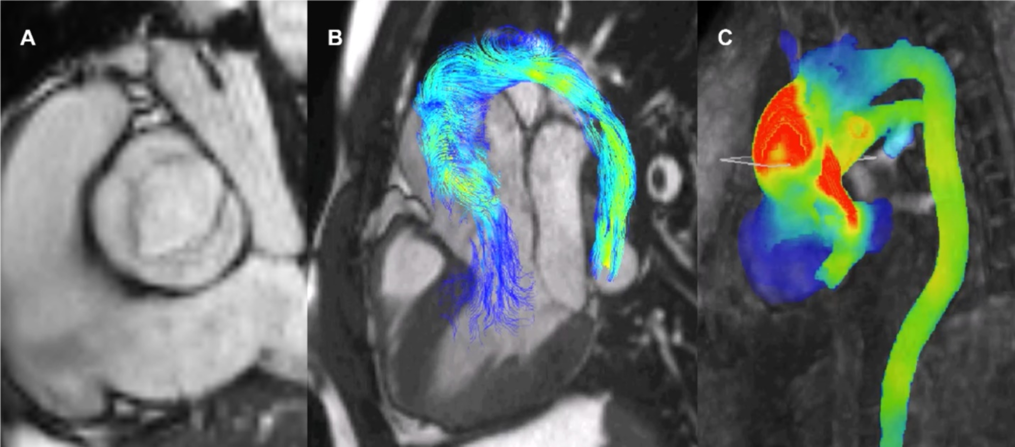 Emerging Role of 4D Flow for Clinical use in Adult Congenital Heart Disease