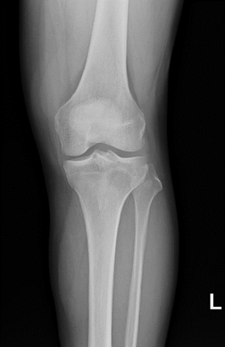 Diagnostic performance of ChatGPT in tibial plateau fracture in knee X-ray