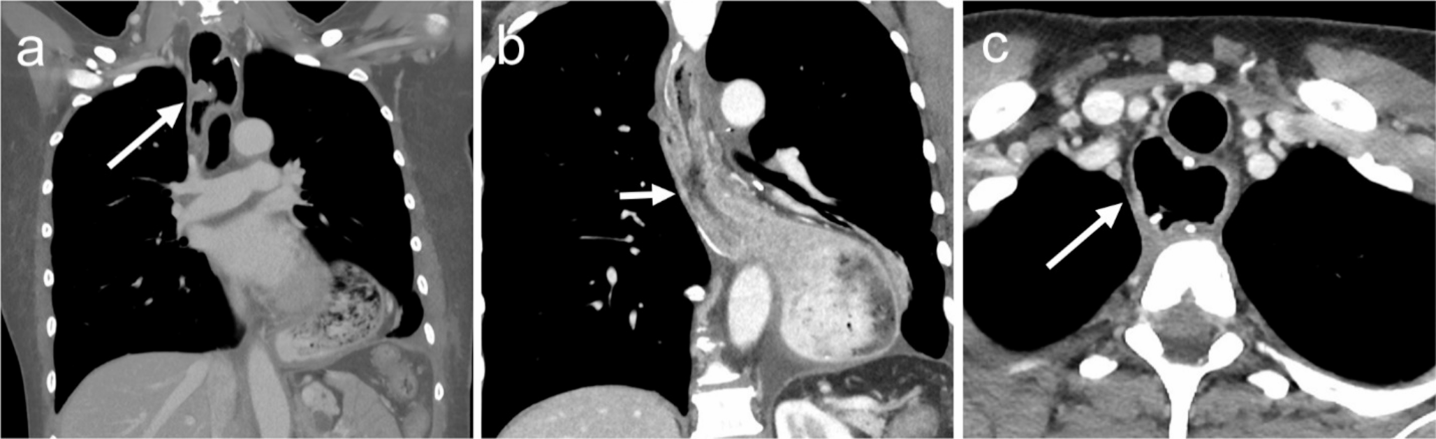 A practical approach to the post esophagectomy CT: expected postoperative anatomy and anatomical approach to associated complication