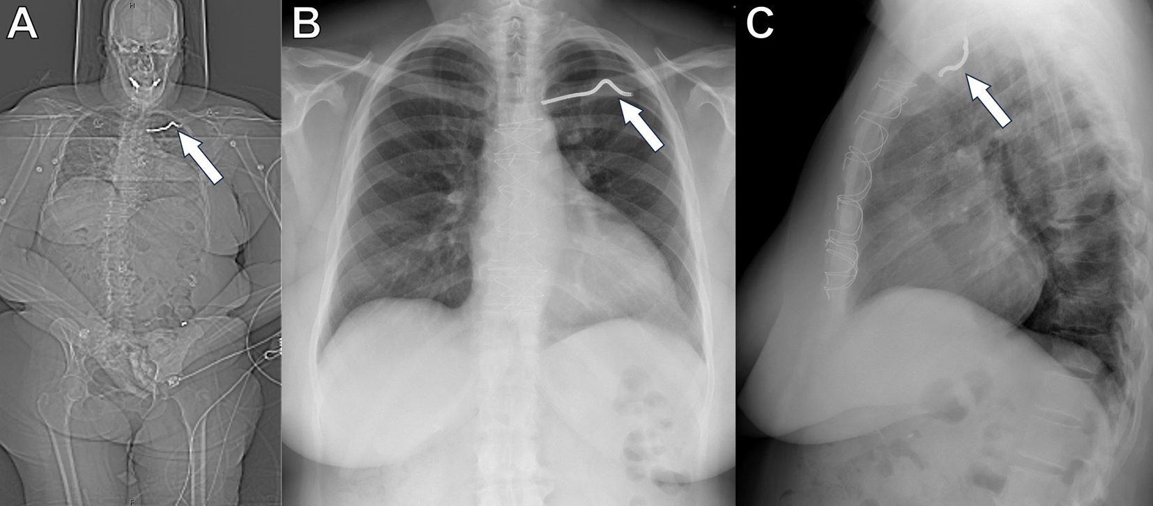 Exploring the role of CT scouts in expediting MRI in acute stroke