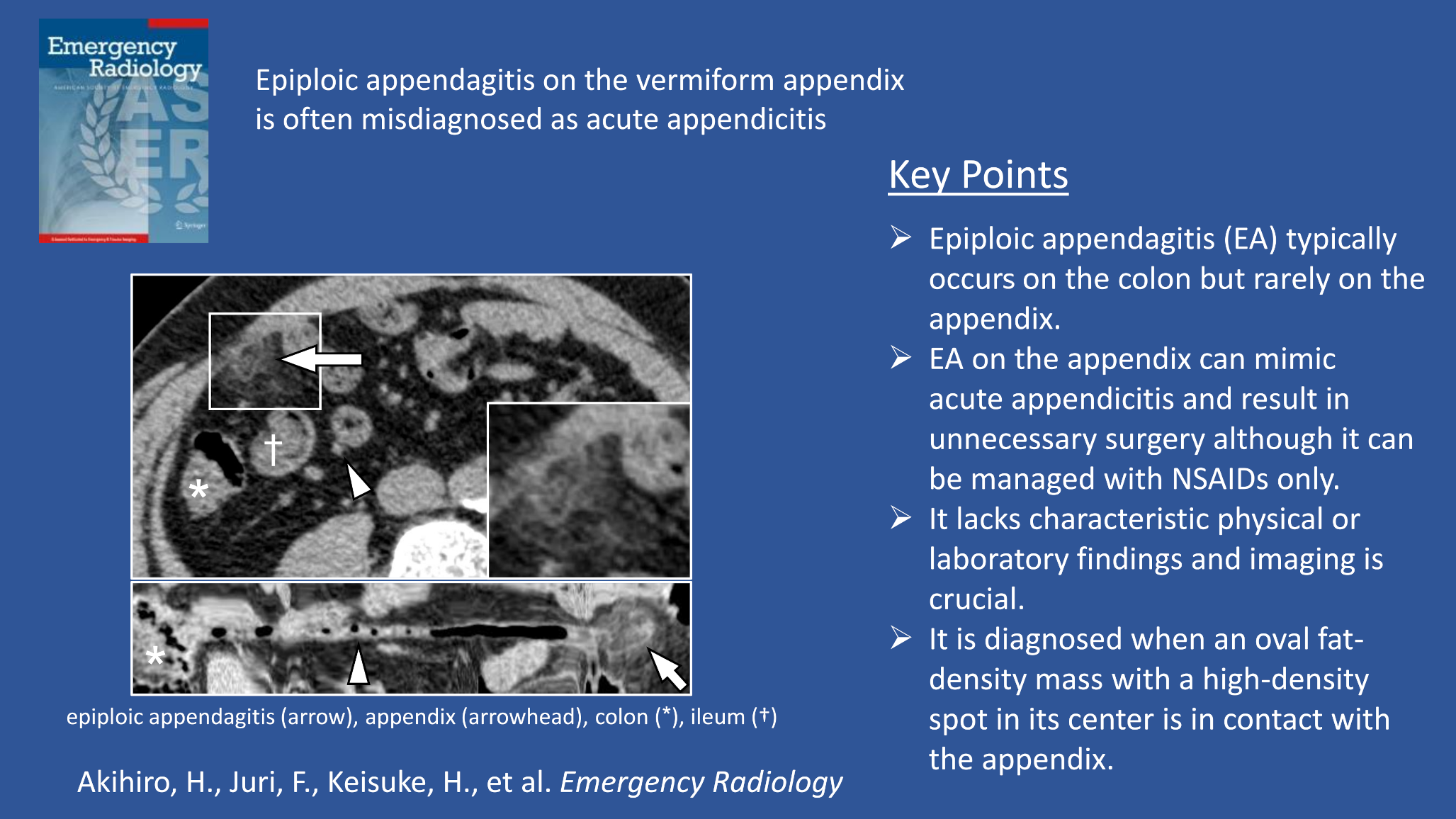 Epiploic appendagitis on the vermiform appendix is often misdiagnosed as acute appendicitis