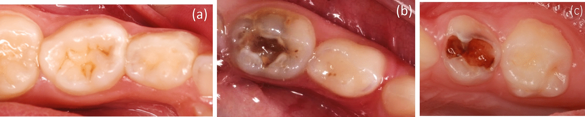 Knowledge, attitudes and preferences of parents/guardians regarding dental treatment of their children’s primary teeth: a questionnaire cross-sectional study