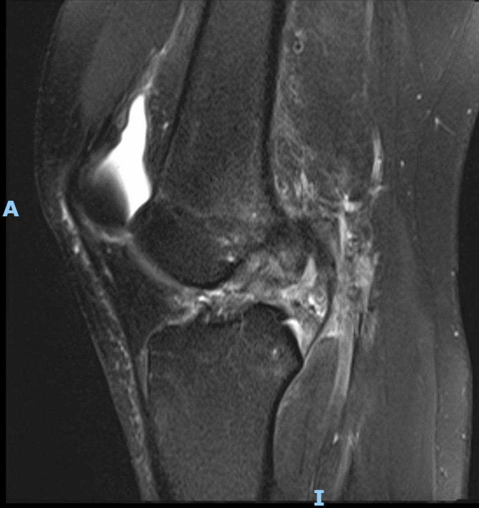 Anterior Cruciate Ligament Tears among Football Players