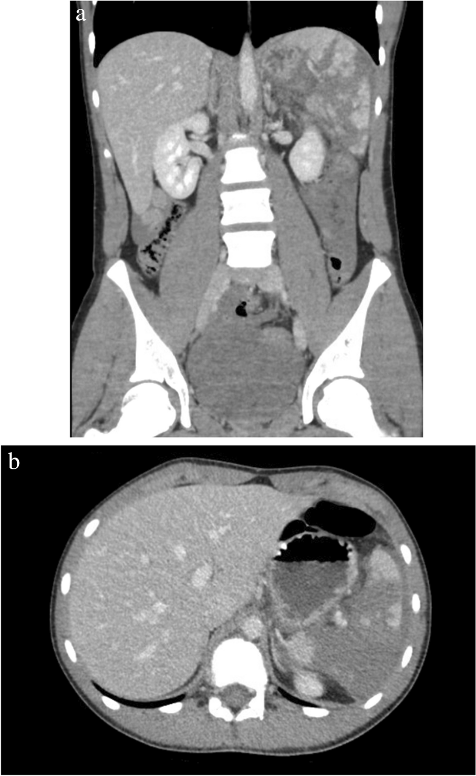 Indications and Use of Angiography and Angioembolization in Pediatric Trauma