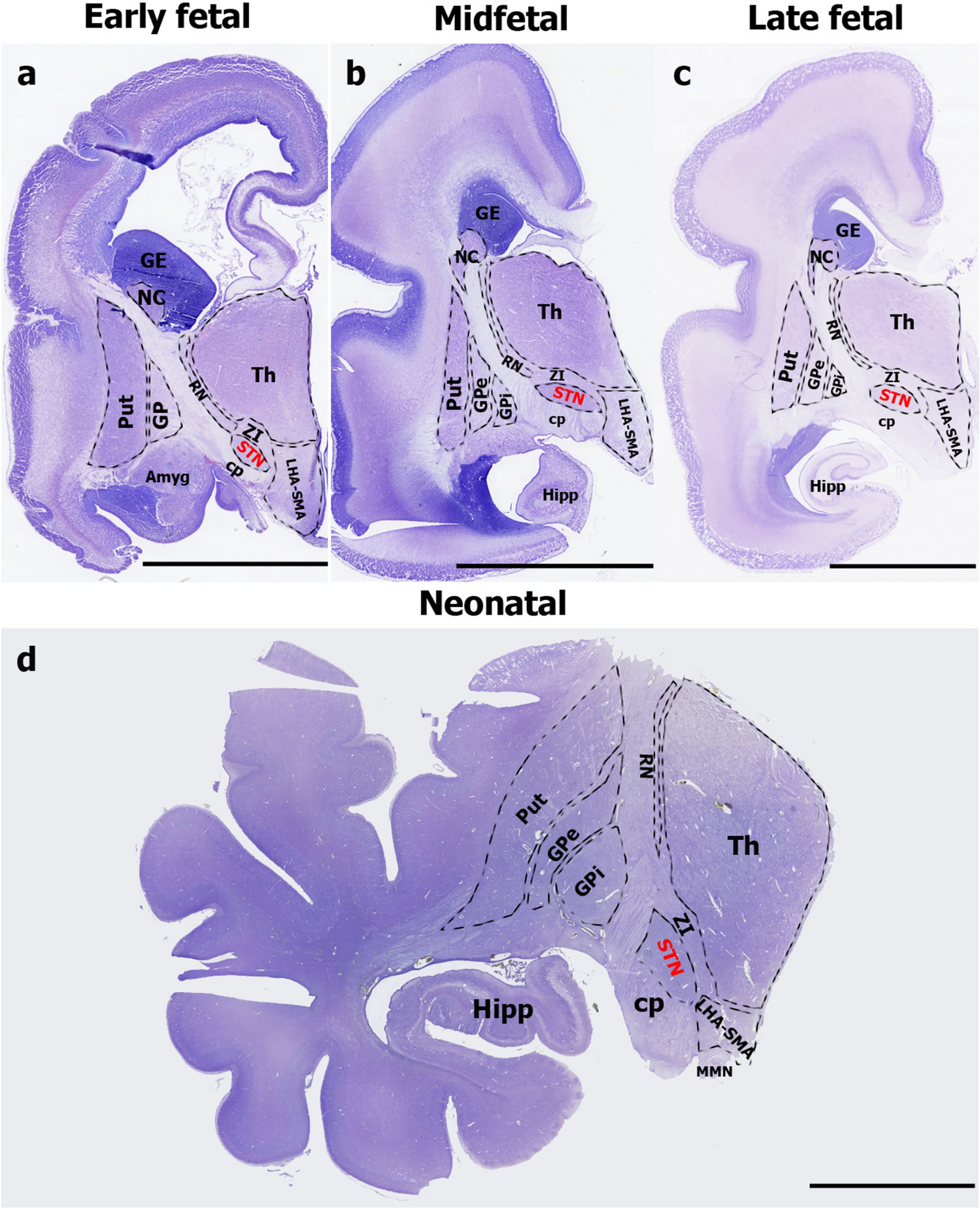 The expression of transcription factors in the human fetal subthalamic nucleus suggests its origin from the first hypothalamic prosomere