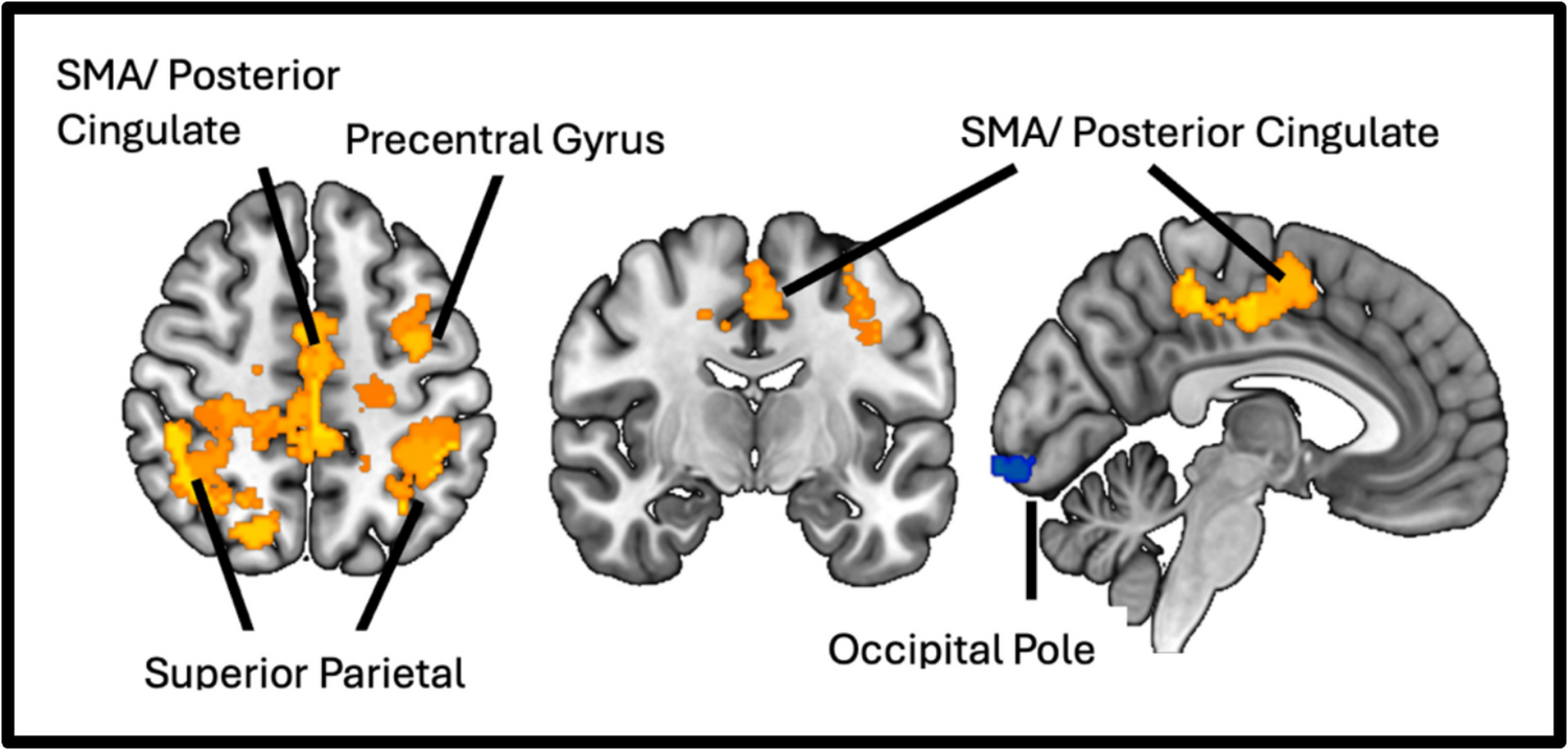 Reduced automaticity in freezing of gait is associated with elevated cortico-cerebellar connectivity