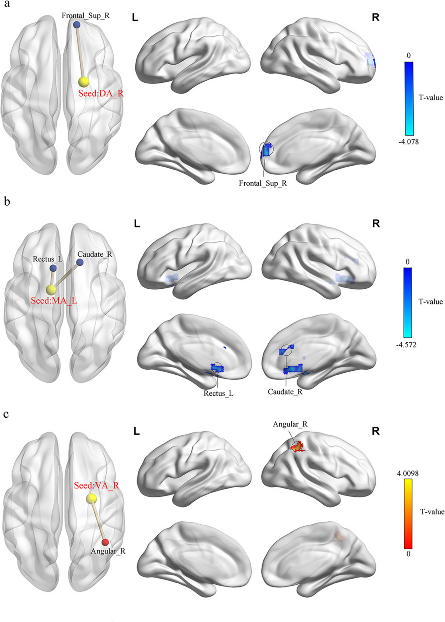 Altered resting-state functional connectivity of amygdala subregions in adults with subthreshold depression after aerobic exercise