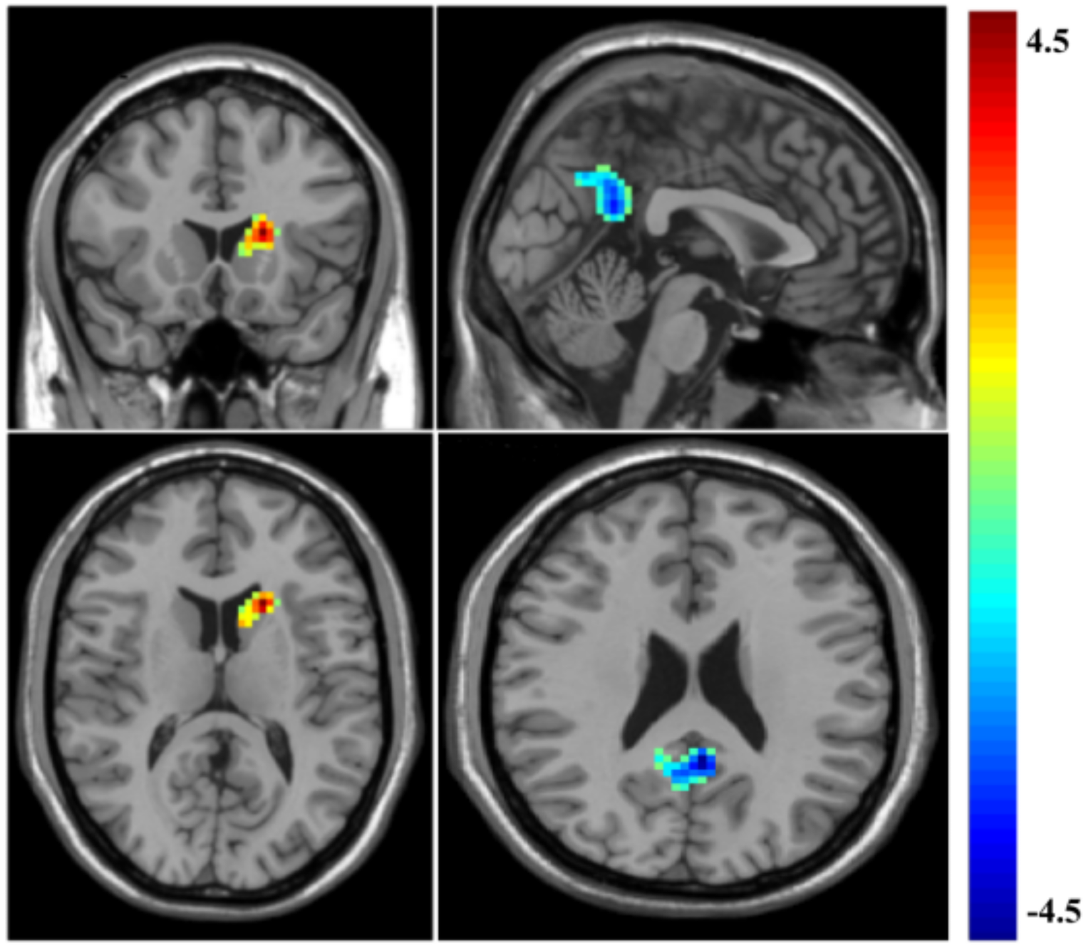 Functional connectivity and white matter microstructural alterations in patients with left basal ganglia acute ischemic stroke