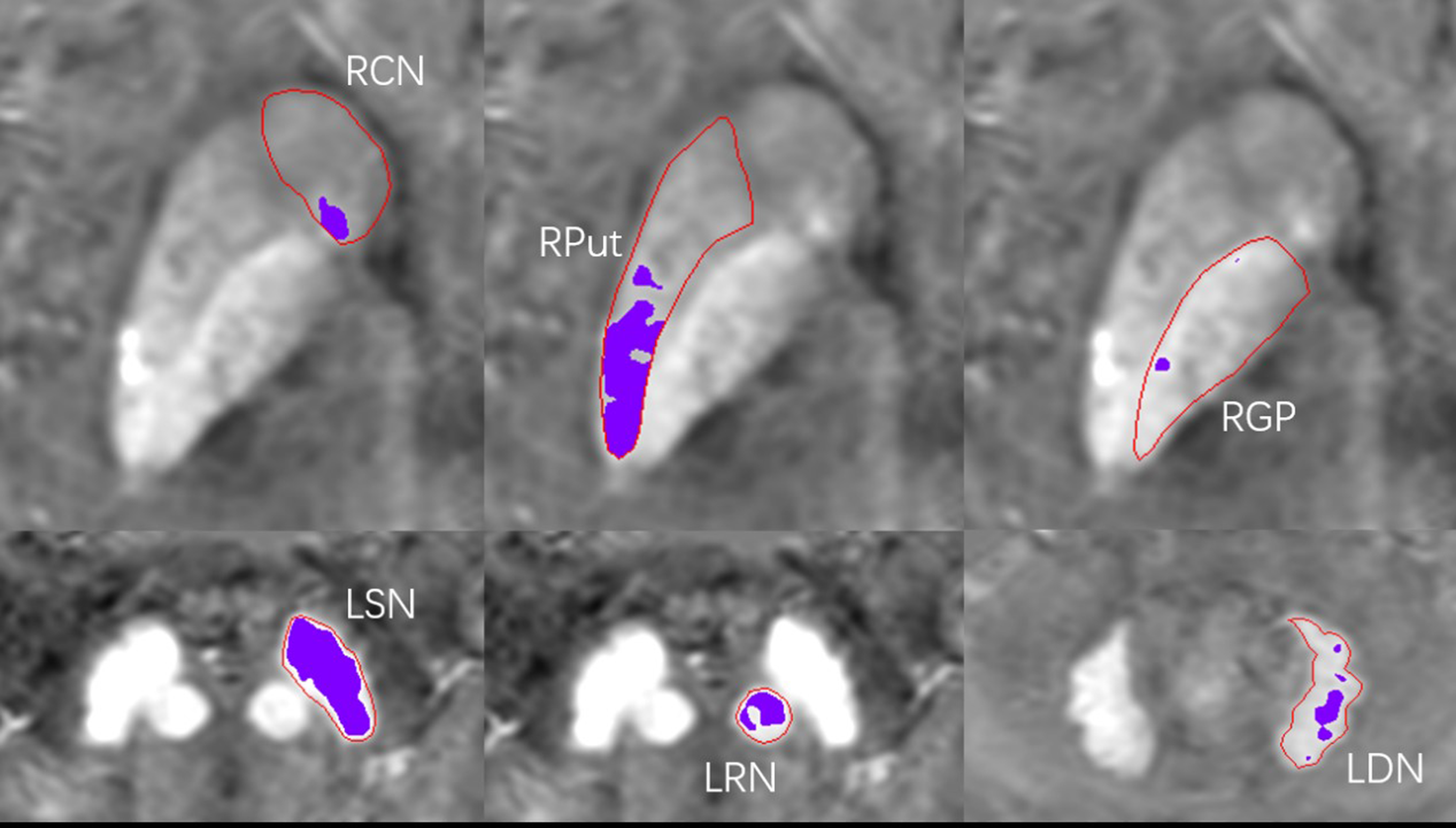 Regional high iron deposition on brain quantitative susceptibility mapping correlates with cognitive decline in chronic kidney disease patients