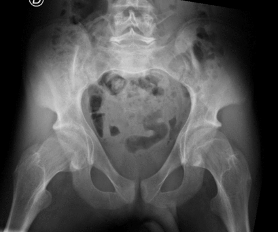 Severe Osteoporosis in an Adult Subject with  Gene Mutation