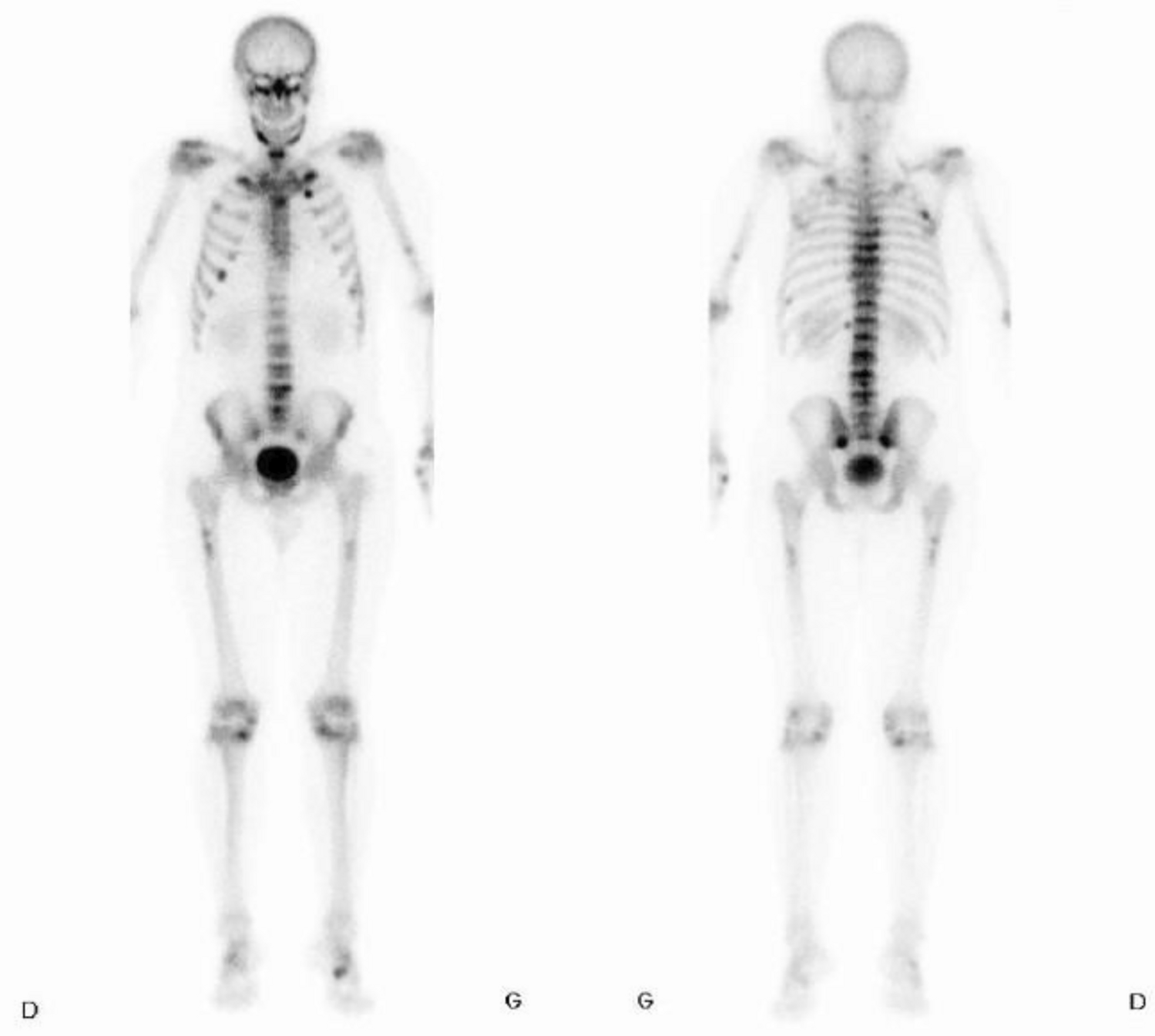 Unusual Association of Partial Fanconi Syndrome and Tumor-Induced Osteomalacia Revealed by Multiple Vertebral Fractures