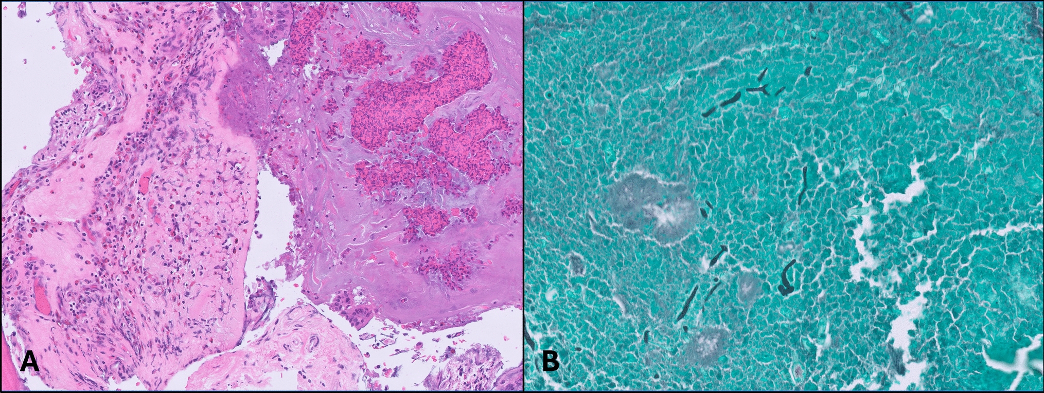 Infectious Diseases in the Head and Neck with Eosinophilia