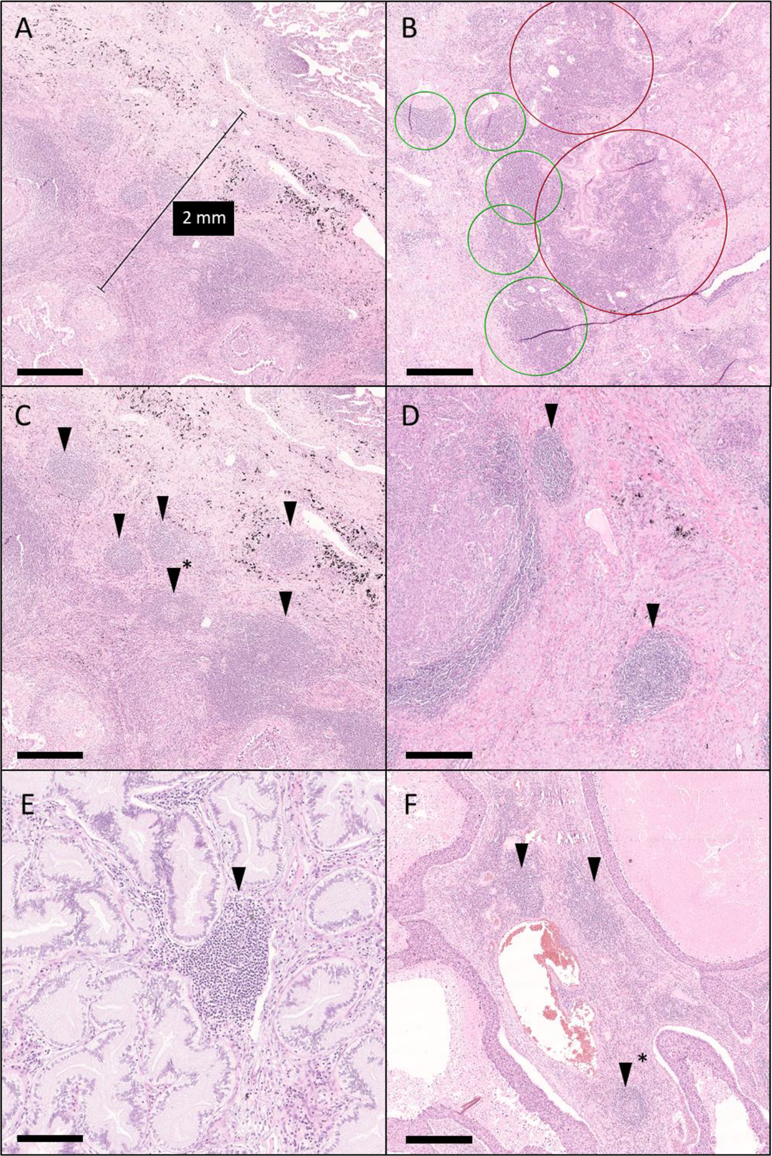 Spatial distribution of tertiary lymphoid structures in the molecular and clinical context of non-small cell lung cancer