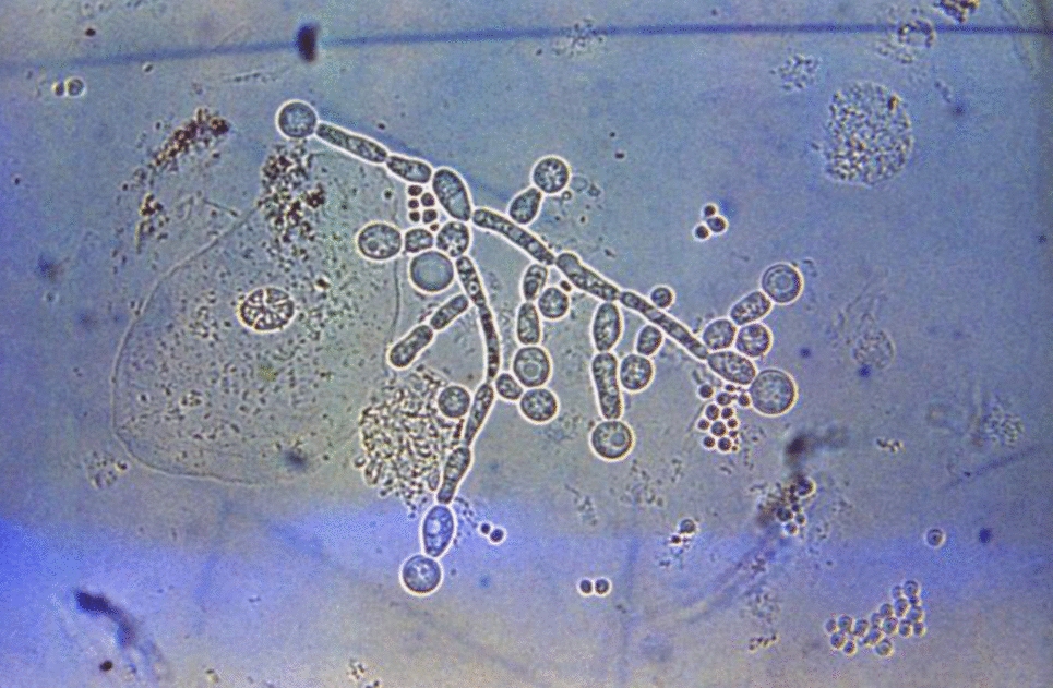 Emerging Treatments in Neonatal Fungal Infections: Progress and Prospects